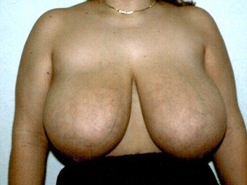 Breast Reduction  Before & After Image