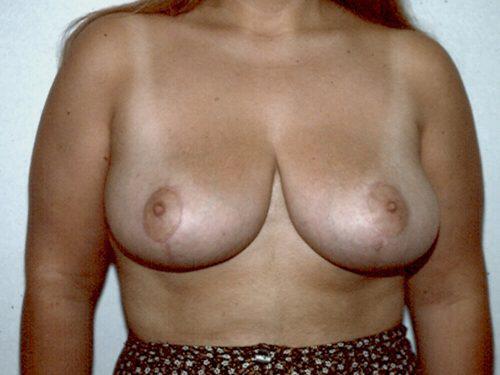 Breast Reduction  Before & After Image