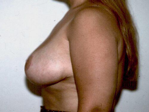 Breast Reduction  Before & After Image