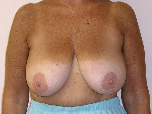 Breast Reduction  Before & After Image