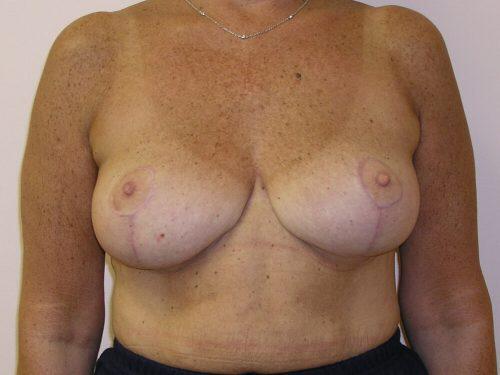 Breast Reduction  Before & After Image