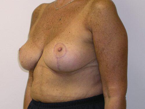 Breast Reduction  Before & After Image