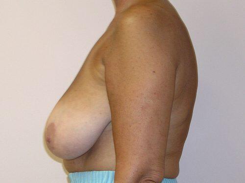 Breast Reduction  Before & After Image