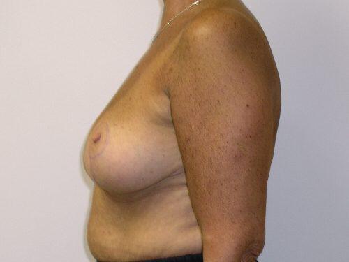 Breast Reduction  Before & After Image