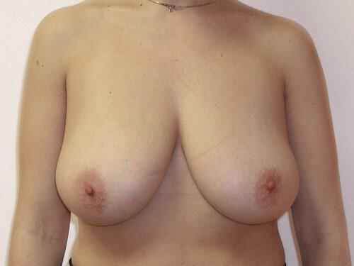 Breast Reduction  Before & After Image