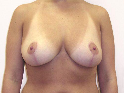 Breast Reduction  Before & After Image