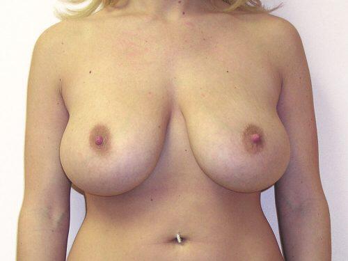 Breast Reduction  Before & After Image