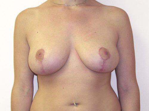 Breast Reduction  Before & After Image