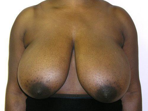 Breast Reduction  Before & After Image