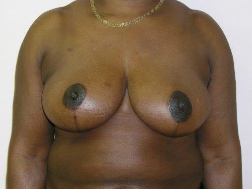 Breast Reduction  Before & After Image