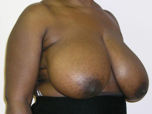 Breast Reduction  Before & After Image