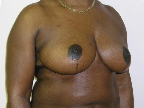 Breast Reduction  Before & After Image