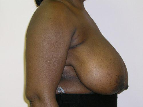 Breast Reduction  Before & After Image