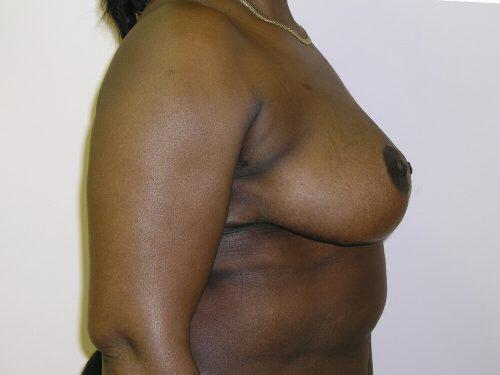 Breast Reduction  Before & After Image