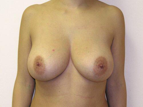 Breast Reduction  Before & After Image