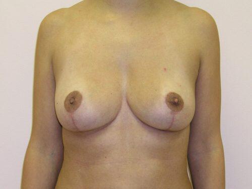 Breast Reduction  Before & After Image