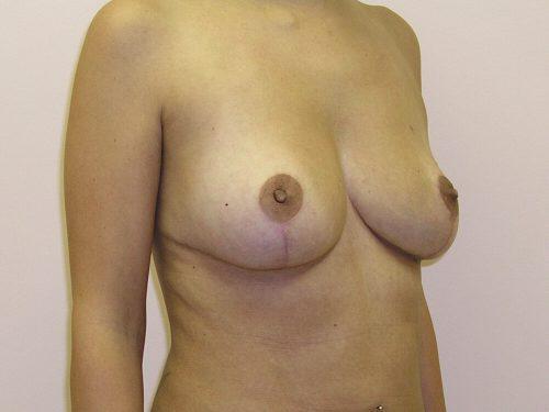 Breast Reduction  Before & After Image