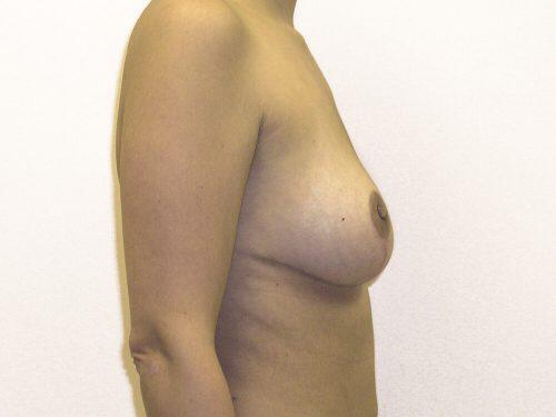 Breast Reduction  Before & After Image