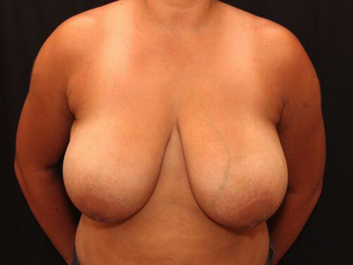 Breast Reduction  Before & After Image