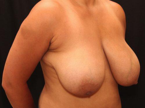 Breast Reduction  Before & After Image