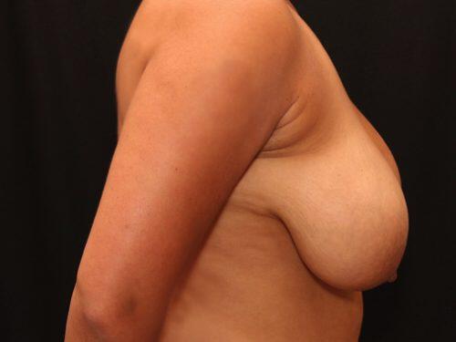 Breast Reduction  Before & After Image