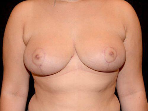 Breast Reduction  Before & After Image