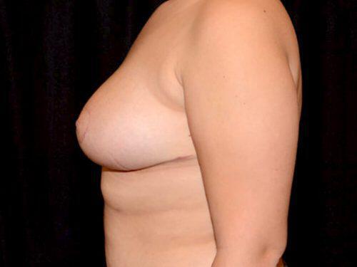 Breast Reduction  Before & After Image