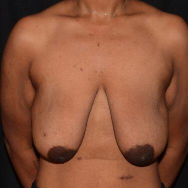 Breast Reduction  Before & After Image