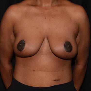 Breast Reduction  Before & After Image