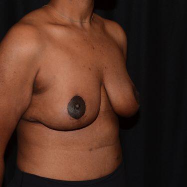 Breast Reduction  Before & After Image