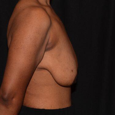 Breast Reduction  Before & After Image