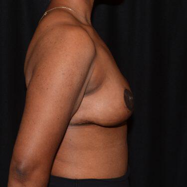 Breast Reduction  Before & After Image