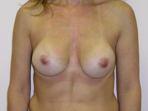 Breast Revision Before & After Image