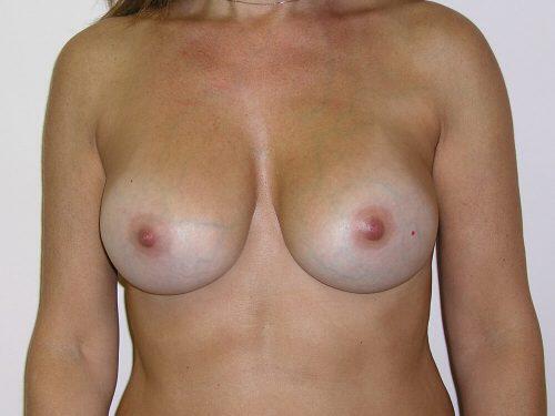 Breast Revision Before & After Image