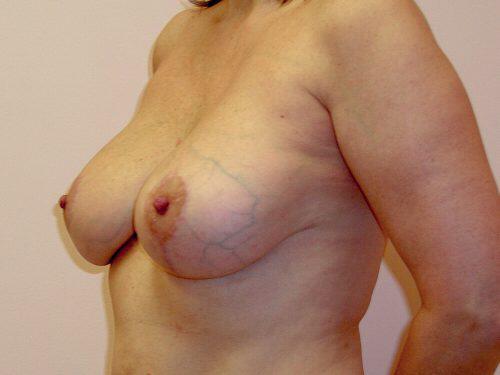 Breast Revision Before & After Image