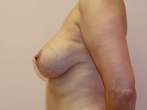 Breast Revision Before & After Image