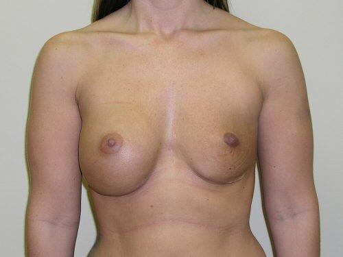 Breast Revision Before & After Image