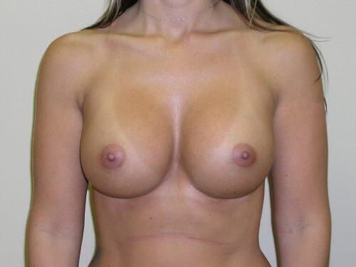 Breast Revision Before & After Image