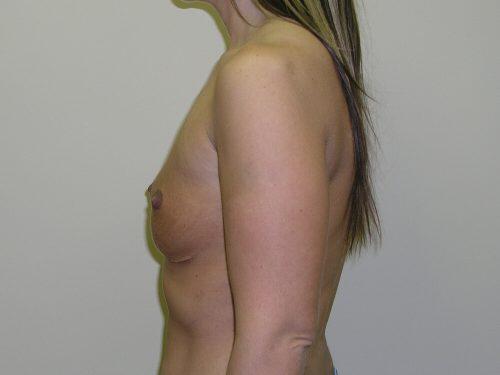 Breast Revision Before & After Image