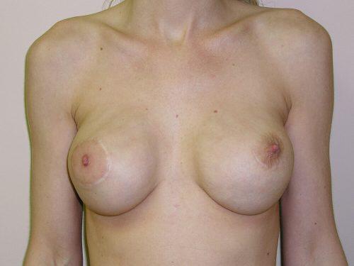 Breast Revision Before & After Image