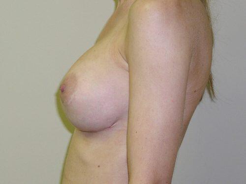 Breast Revision Before & After Image