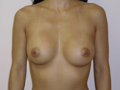 Breast Revision Before & After Image