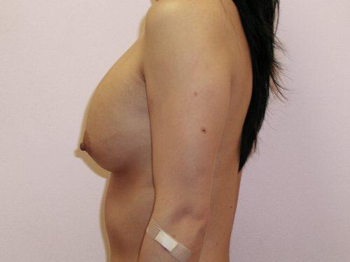 Breast Revision Before & After Image