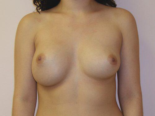 Breast Revision Before & After Image