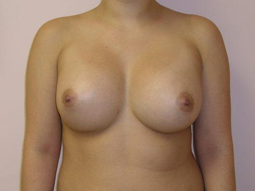 Breast Revision Before & After Image