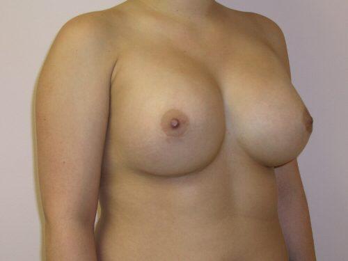 Breast Revision Before & After Image