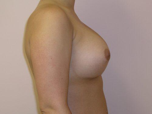 Breast Revision Before & After Image