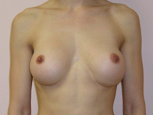 Breast Revision Before & After Image