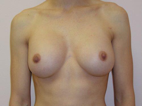 Breast Revision Before & After Image