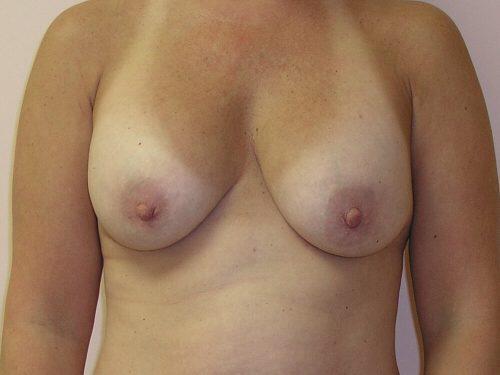 Breast Revision Before & After Image